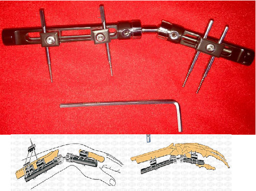 trauma FIJADOR EXTERNO DINÁMICO DE MUÑECA PENNING